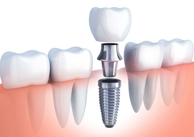 Best Dental implants treatment in Rajahmundry