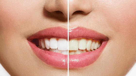 teeth whitening treatment in Rajahmundry